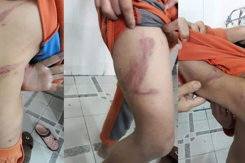 Người cha 'dạy con' đến thâm người, rướm máu do 'học chậm so với bạn bè'