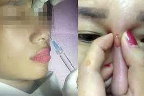 Đi nâng mũi ở spa, cô gái trẻ 25 tuổi ở Hà Nội nhập viện vì hoại tử