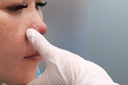 Mũi miệng bầm tím, mặt biến dạng sau tiêm chất làm đầy tại spa