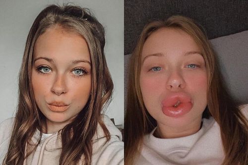Ham tiêm filler giá rẻ, người phụ nữ nhận về đôi môi sưng phồng biến dạng
