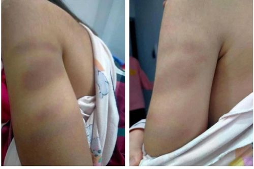 Cô giáo đánh tím tay học sinh lớp 1