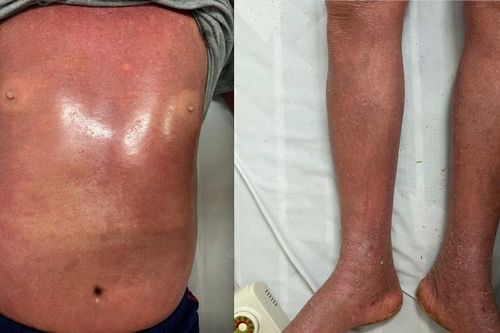 Người đàn ông toàn thân đỏ như tôm luộc vì kiểu 'chăm sóc da' này
