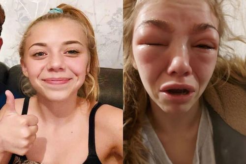 Cô bé 14 tuổi suýt mất mạng vì ham nhuộm lông mày, nối mi
