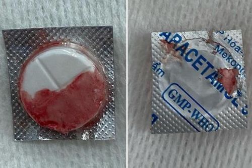 Gắp thành công viên thuốc nguyên vỏ trong thực quản cho bé trai