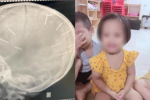 Vụ bé gái 3 tuổi ở Hà Nội bị đinh găm vào đầu: Nghi phạm lì lợm, quanh co chối tội
