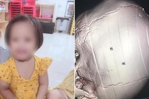 Gia đình bé gái bị đóng đinh vào đầu cho biết bé có sự chuyển biến rõ rệt về sức khỏe