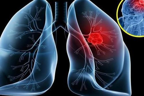 Ung thư phổi di căn não - Căn bệnh khiến nghệ sĩ Tiến Hợi qua đời có phòng được không?