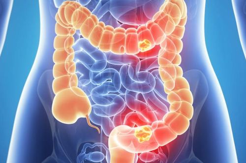 5 dấu hiệu sớm của bệnh ung thư ruột: Cảnh báo ca bệnh tăng gấp đôi ở người trẻ