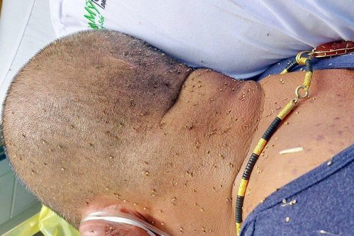 Suýt chết vì hàng trăm vết ong đốt