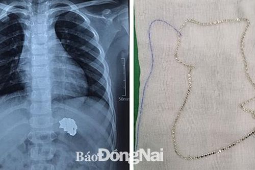 Nội soi gắp dị vật là sợi dây chuyền trong dạ dày bé gái
