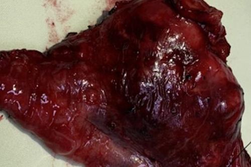 Bệnh viện 30-4 cứu sống nữ bệnh nhân có lá gan đầy ắp sỏi