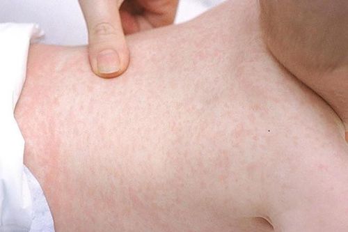 Cách xử trí phát ban và ngứa ở trẻ khi mắc COVID-19