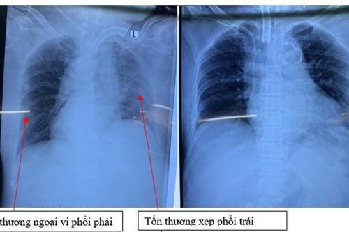 Cứu sống ca COVID-19 tiền sử tăng huyết áp kèm đột quỵ