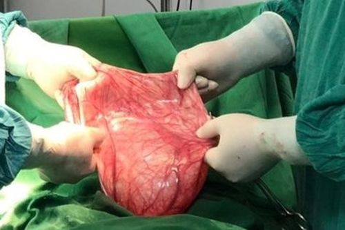 Bụng ngày càng to, đi khám phát hiện khối u buồng trứng nặng 12kg