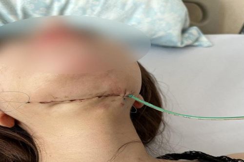 Cô gái phải 'cứa cổ' vì tiêm tan mỡ nọng cằm