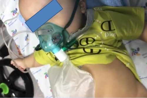 Trẻ mắc COVID-19 gây viêm thanh quản cấp suy hô hấp nặng