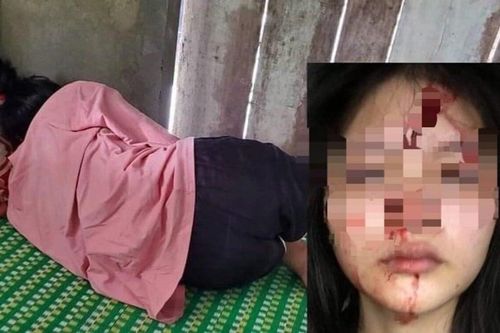 Nữ sinh lớp 10 ở Huế bị bạn cùng trường đánh đến chấn động não