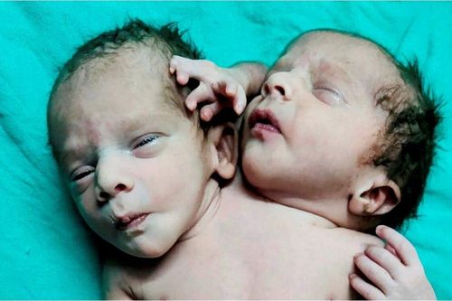 Hy hữu: Mẹ đi siêu âm thai đôi nhưng sinh ra em bé 2 đầu 3 tay