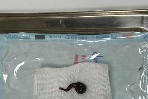 Đỉa dài 5cm sống trong mũi người đàn ông hơn 20 ngày