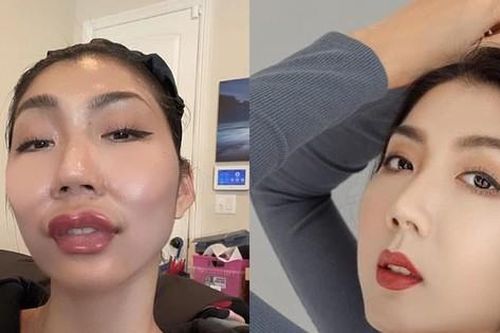 'Sốc' nặng với siêu mẫu kỳ cựu khoe gương mặt sưng phồng vì mới đụng dao kéo