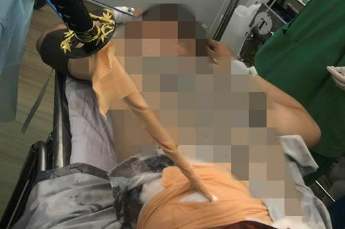 Cấp cứu nạn nhân bị kiếm đâm xuyên thắt lưng