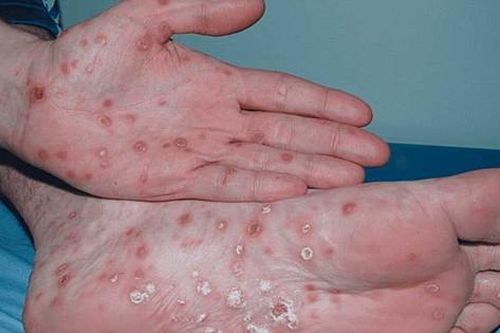 Quan hệ tình dục bừa bãi, nam thanh niên 22 tuổi ở Hà Nội nhận 'trái đắng'