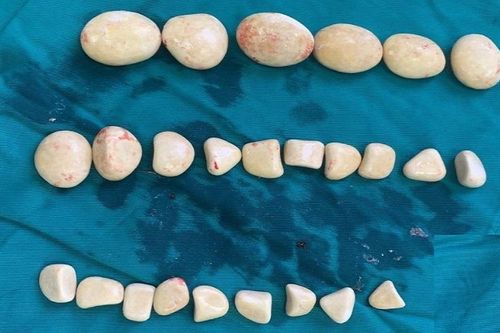 'Ổ sỏi' hàng chục viên trong bàng quang nam bệnh nhân