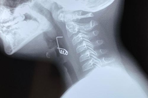 Lò xo 2 càng chặn ngang cổ họng bé trai 9 tuổi