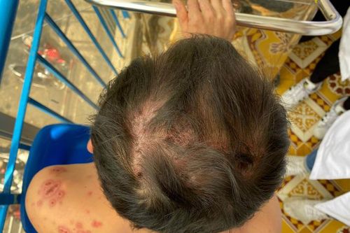Bệnh nhân ở Long An mắc hội chứng rất hiếm gặp