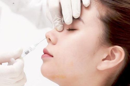 Tiêm thử filler làm đẹp, người phụ nữ hoại tử cả vùng mũi