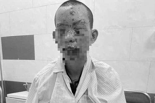 Mất thị lực, sém toàn thân vì tai nạn sử dụng điện thoại khi đang sạc