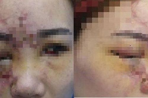 Từ vụ mất thị lực do tiêm filler tại tiệm tóc: Đừng mù quáng ham rẻ mà 'giao trứng cho ác'