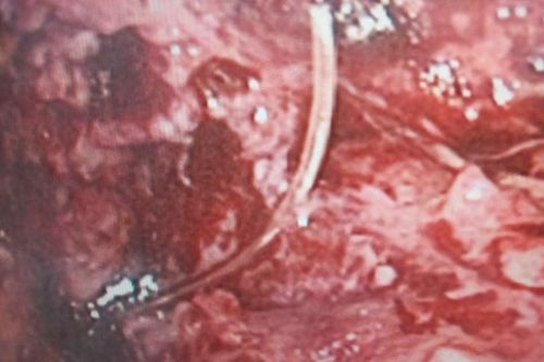 Cụ ông suýt mất mạng vì chiếc xương cá