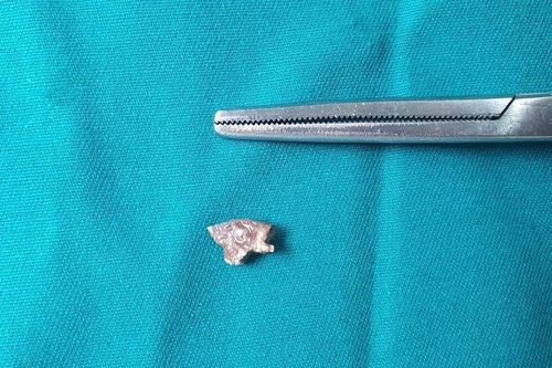 Mảnh xương lợn 'kẹt' trong phế quản cụ ông hàng tháng trời