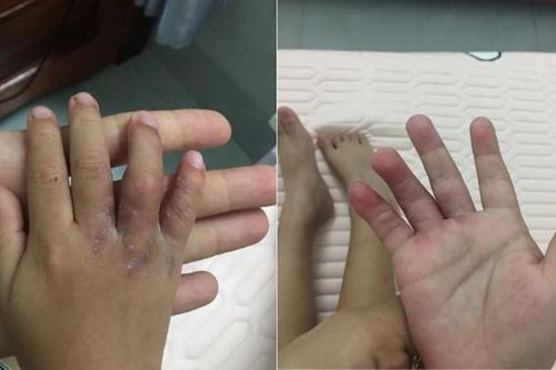 Tách thành công 2 bàn tay dính ngón cho bé 19 tháng tuổi