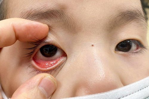 Virus SARS-CoV-2 có thể nhân lên trong niêm mạc mắt