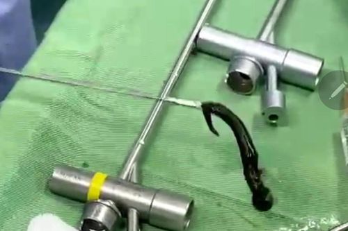 Kinh hãi vắt rừng căng máu ký sinh trong đường thở bé 6 tuổi