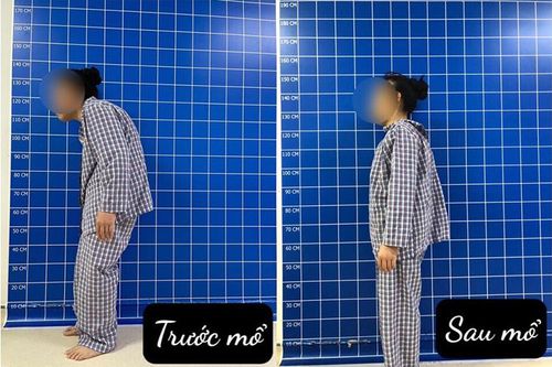 'Cân não' phẫu thuật chỉnh gù cho bệnh nhân nhiễm HIV