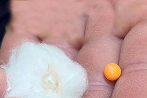 Liên tiếp nhiều trẻ nhập viện cấp cứu do hóc dị vật