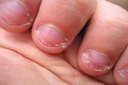 Cậu bé suýt bị cắt cụt chi chỉ vì cắn móng tay thường xuyên
