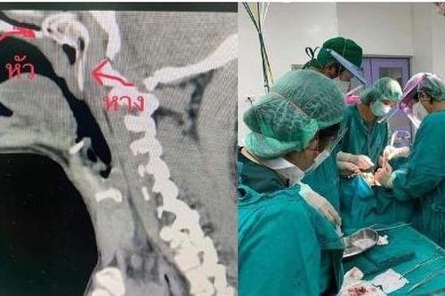 Thái Lan: Người đàn ông suýt chết vì bị cá rô nhảy vào cổ họng
