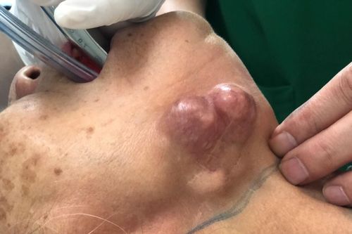 Có những dấu hiệu sau ở vùng đầu cổ mặt, cẩn thận bị loại ung thư cực kỳ nguy hiểm, gây tử vong cao