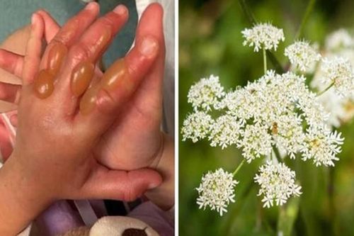 Hè đi chơi vô tình chạm vào cây này, bé gái bỏng cấp 3