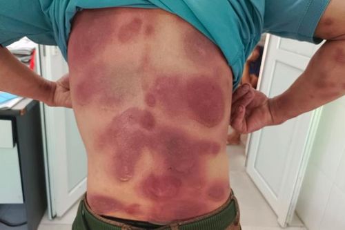 Ngộ độc toàn thân do tự mua thuốc về uống