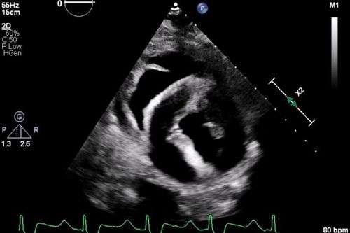 Bí ẩn cái chết của người đầu tiên được ghép tim lợn