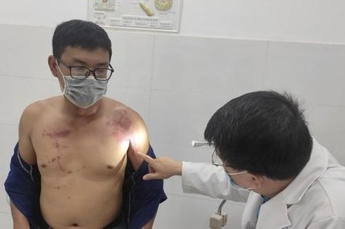 Cảnh báo bỏng da do kiến ba khoang