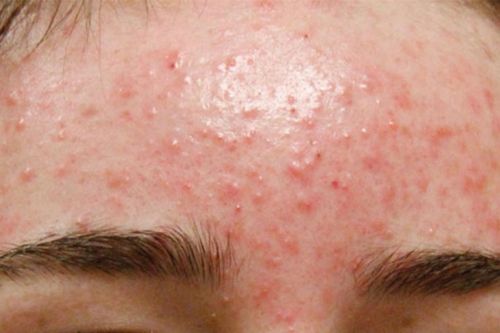 Thủ phạm gây mụn trứng cá không phải ai cũng biết