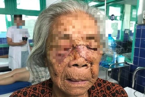 Phẫu thuật cắt khối u, ghép da mặt cho cụ bà 87 tuổi