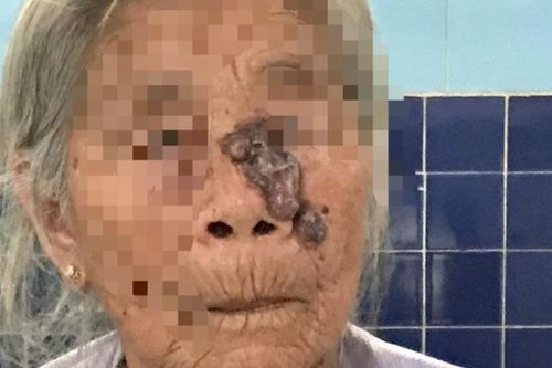 Từ nốt ruồi trên mặt, sau 3 tháng đi khám phát hiện ung thư da