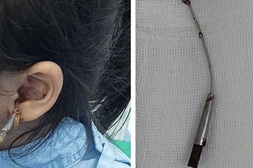 Kinh hãi bé gái 6 tuổi bị que lấy ráy tai đâm xuyên vào tai giữa, bài học cho nhiều gia đình!